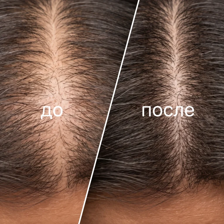Applying Hair Booster leave-in serum to the scalp along the partings